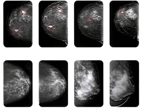 mammografia-3d-migliora-lo-screening-senologico-z3xmi